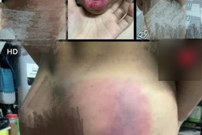 Nha Trang: Báo cáo chính thức vụ cháu bé 8 tuổi bị đánh chảy máu miệng