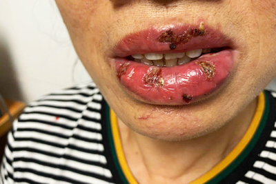 Một người phụ nữ bị viêm da nhiễm trùng, biến chứng khi xăm môi