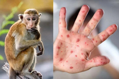 Ghi nhận 135 trường hợp mắc đậu mùa khỉ, Hà Nội chủ động phòng, chống bệnh