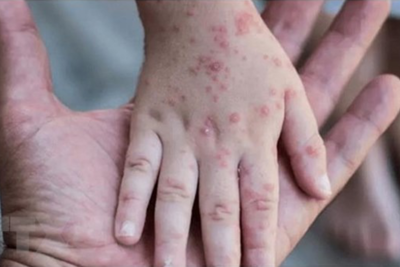 Kiên Giang: Phát hiện ba trường hợp nhiễm đậu mùa khỉ