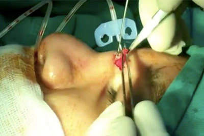 Phát hiện gạc trong mũi bệnh nhân sau 2 năm phẫu thuật nâng mũi