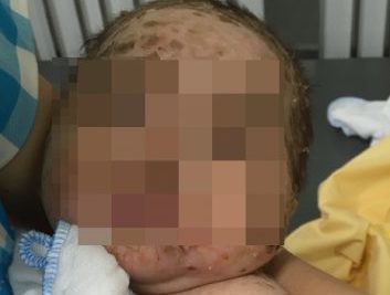 Trẻ 4 tháng bị nhiễm độc da vì mẹ tắm lá chữa thủy đậu