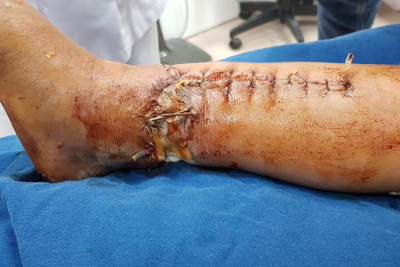 Bé trai 7 tuổi bị máy xúc làm dập nát chân