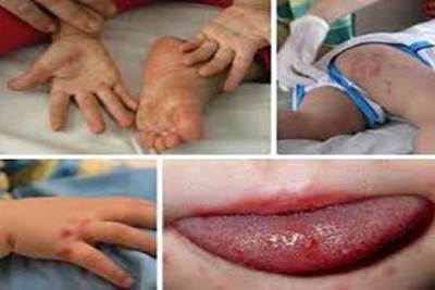 [Infographic] Đừng chủ quan với bệnh tay chân miệng ở trẻ em