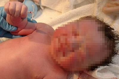 Sự thật về em bé chào đời trên tay cầm sẵn vòng tránh thai