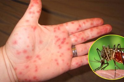 [Infographic] Cách chủ động phòng bệnh sốt xuất huyết hiệu quả