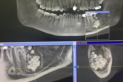 Bác sĩ gắp bỏ khối u chứa nhiều răng nhỏ trong miệng nam thanh niên