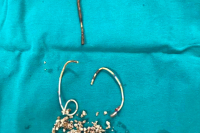 Bệnh nhân gặp biến chứng vì bị bỏ quên ‘stent jj’ trong 5 năm