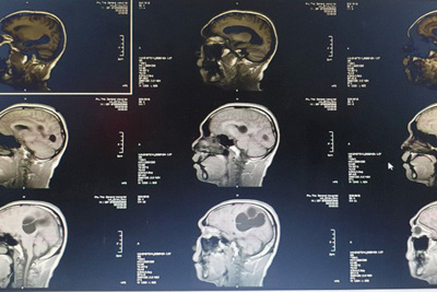 Bệnh nhân nam liệt nửa người do sán làm tổ trong não