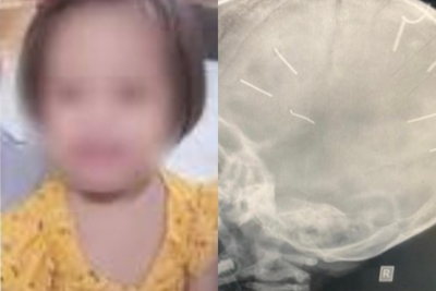 Thông tin mới nhất vụ bé gái 3 tuổi nghi bị găm đinh vào đầu