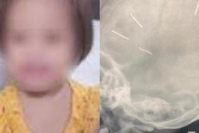 Hỗ trợ khẩn cấp bé gái 3 tuổi nghi bị 9 đinh găm vào đầu