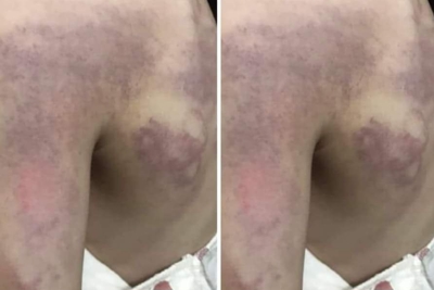 Nghệ An: Làm rõ vụ việc học sinh lớp 3 bị giáo viên đánh bầm lưng