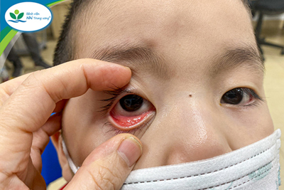 Đau mắt đỏ ở trẻ hậu Covid-19: Chớ chủ quan, tự chữa tại nhà