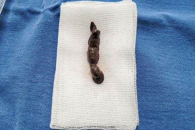 Phát hiện con đỉa dài 4 cm sống lâu ngày trong khí quản bé 4 tuổi