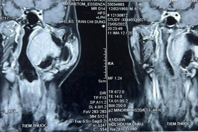 Phẫu thuật thành công khối u vùng đầu cổ phức tạp, hiếm gặp