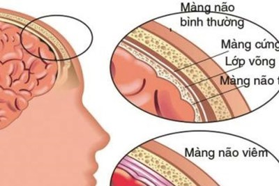 Bệnh viêm màng não ở trẻ em rất nguy hiểm, có thể dẫn đến tử vong