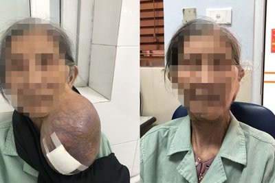Cụ bà 40 năm "đeo" khối u khổng lồ trên mặt