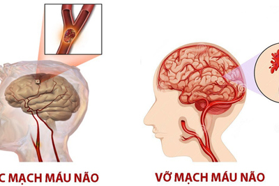 Chuyên gia chỉ cách nhận biết sớm và sơ cứu bệnh nhân đột quỵ não