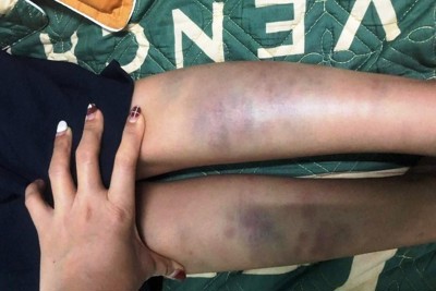 Học sinh bị bầm tím chân tay ở Đà Nẵng là do bạn đánh
