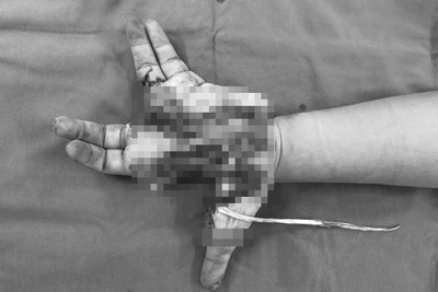 Điện thoại phát nổ khiến bàn tay bé trai 14 tuổi bị dập nát 