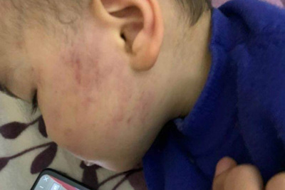 Thái Bình: Bé trai 2 tuổi bị giáo viên tát bầm tím một bên má 