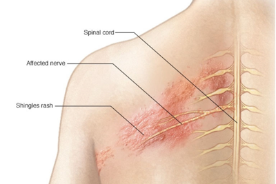 Bệnh zona thần kinh: Triệu chứng và cách điều trị