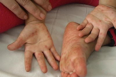 Bệnh tay chân miệng vào mùa: Cha mẹ lưu ý để bệnh không trở nặng