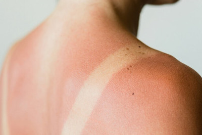 Cần làm gì khi da bị cháy nắng?