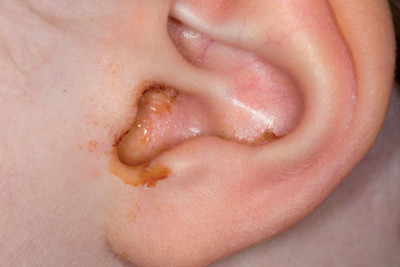 Cách vệ sinh tai cho trẻ bị viêm tai giữa
