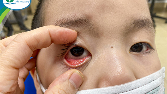 Những nguy cơ nào có thể làm tăng nguy cơ mắc đau mắt đỏ do viêm kết mạc?
