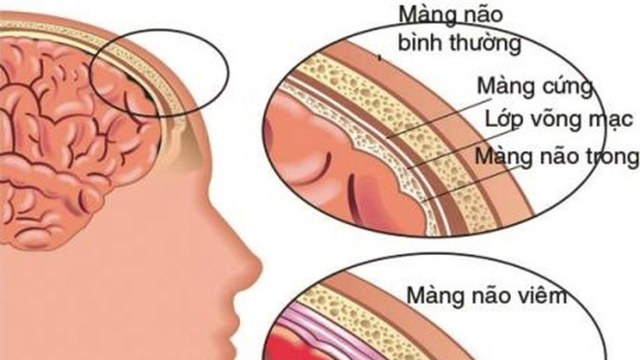 Bệnh viêm màng não ở trẻ sơ sinh có thể dẫn đến những biến chứng nguy hiểm nào?
