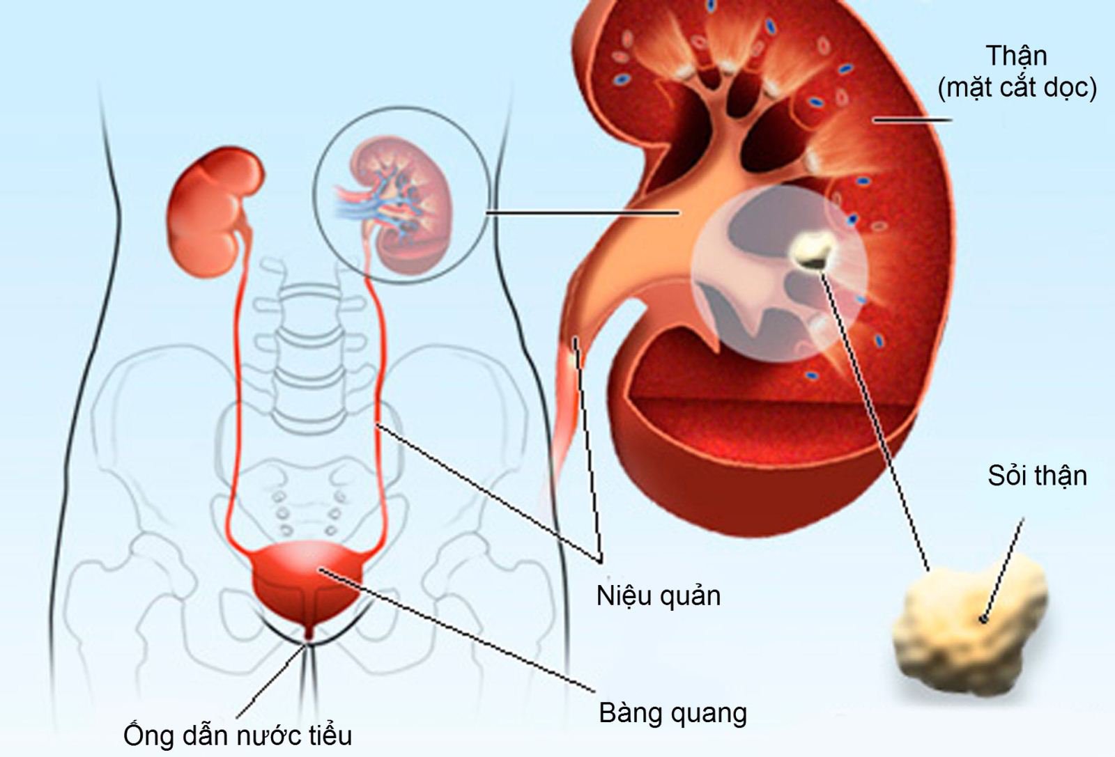 Nguyên Nhân Gây Ra Bệnh Sỏi Thận