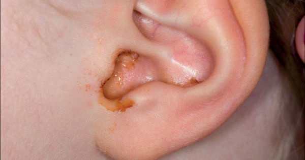 Cách vệ sinh tai cho trẻ bị viêm tai giữa