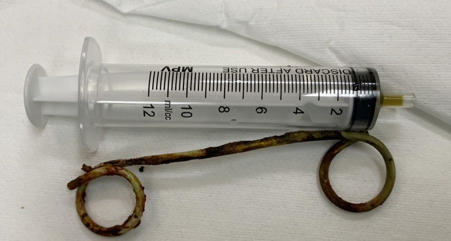 Đoạn Stent dài  15 cm nằm 6 năm trong ống mật chủ của cụ bà 77 tuổi phẫu thuật lấy ra