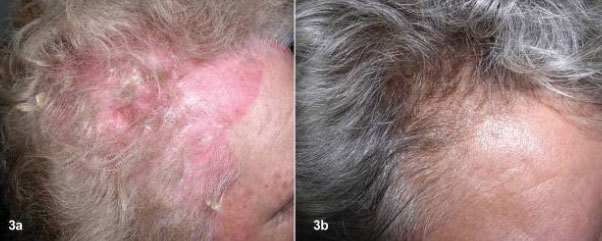 Nghiên cứu mới về điều trị vảy nến da đầu - Ảnh 1