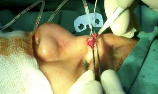 Phát hiện gạc trong mũi bệnh nhân sau 2 năm phẫu thuật nâng mũi - Ảnh 1