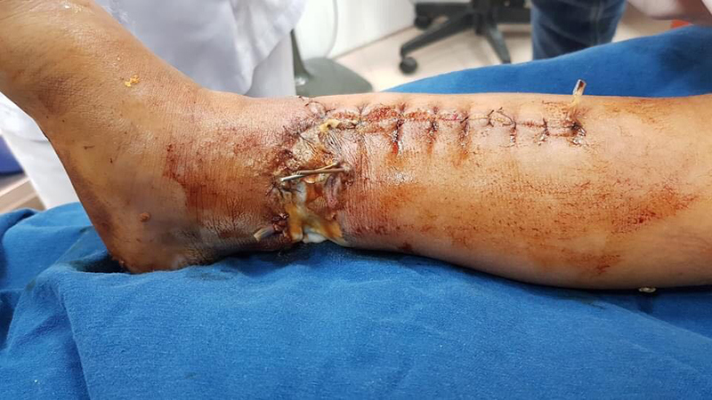 Bé trai 7 tuổi bị máy xúc làm dập nát chân - Ảnh 1