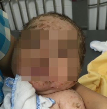 Trẻ 4 tháng bị nhiễm độc da vì mẹ tắm lá chữa thủy đậu - Ảnh 1