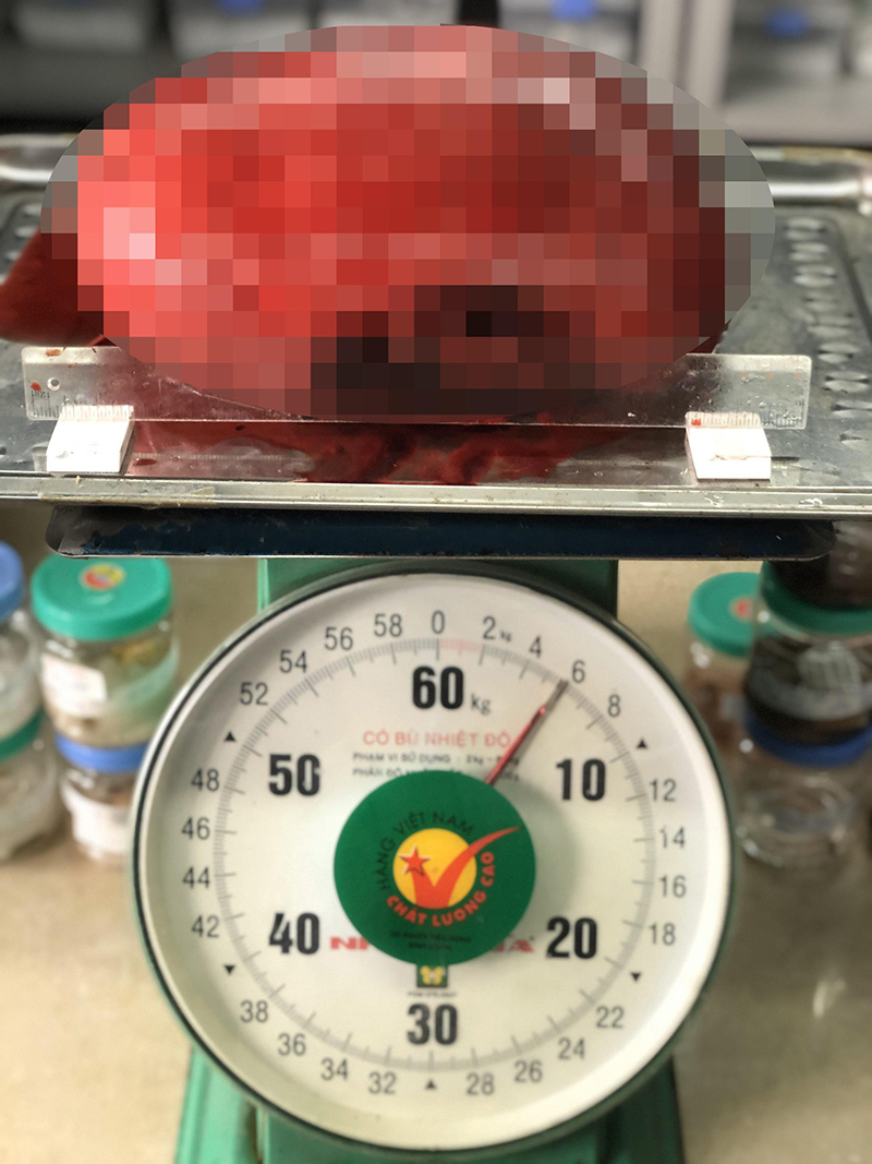Tưởng béo bụng, không ngờ mang khối u “khủng” nặng 6kg - Ảnh 1