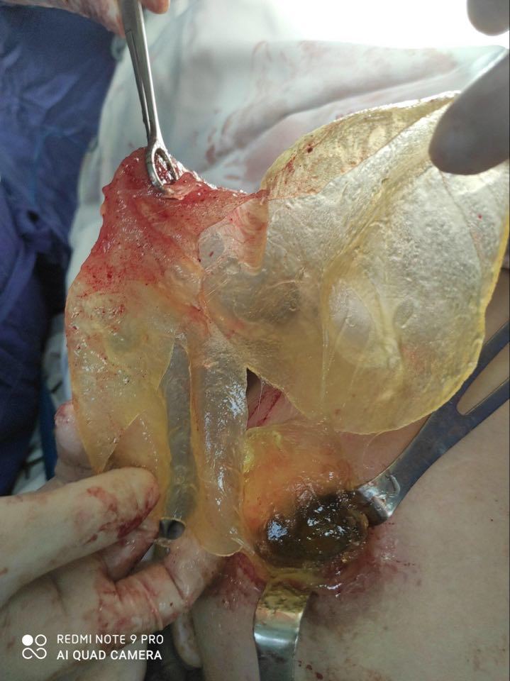 Bị vỡ túi silicon, người phụ nữ phát hiện u ở ngực - Ảnh 1