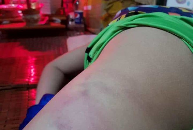Một cô giáo bị tố đánh học sinh bầm tím cơ thể ở Bình Định - Ảnh 1