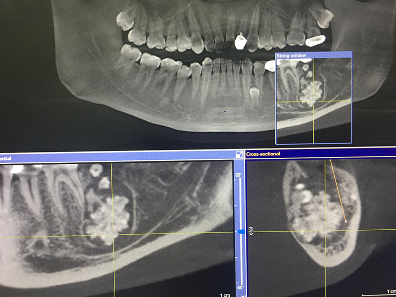 Bác sĩ gắp bỏ khối u chứa nhiều răng nhỏ trong miệng nam thanh niên - Ảnh 1
