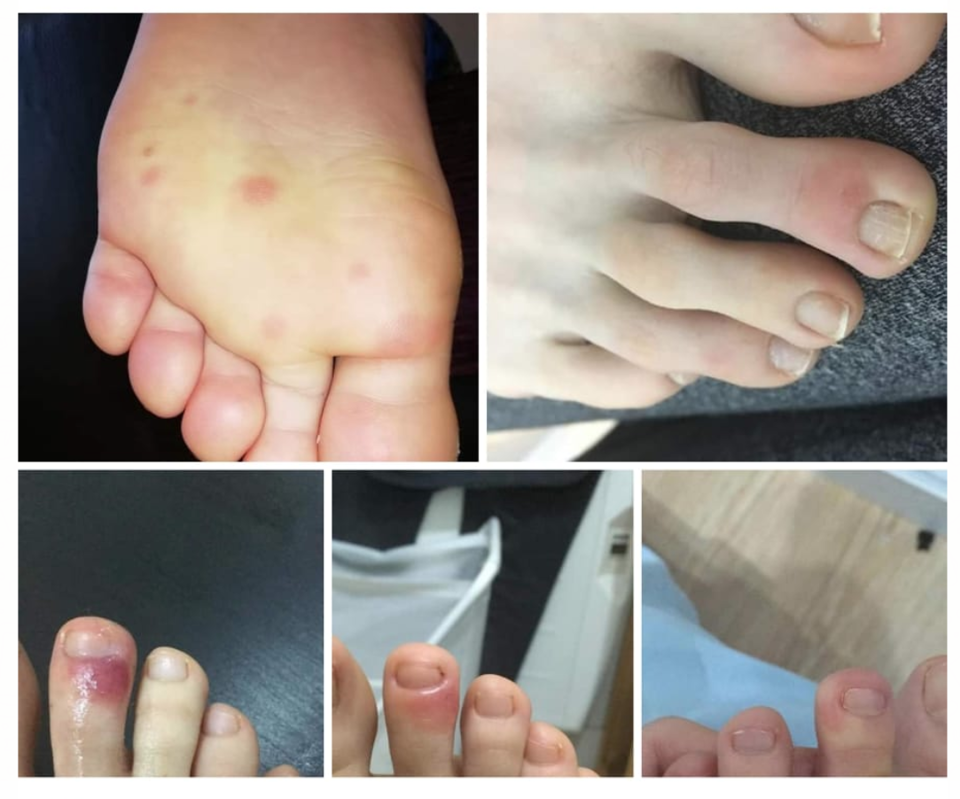 Thực hư triệu chứng lạ trên bàn chân người nhiễm Covid-19 - Ảnh 1