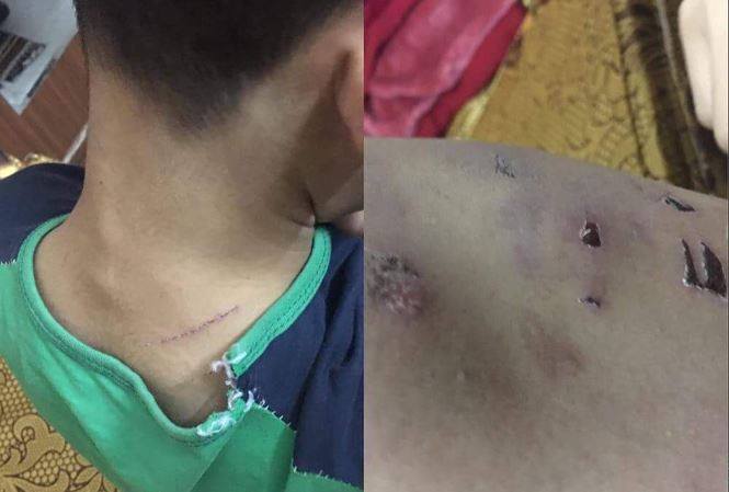 Hà Nội: Thêm một bé trai 9 tuổi nghi bị bố đẻ bạo hành - Ảnh 1