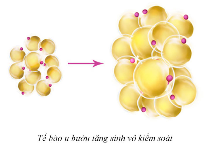 Khối u bướu hình thành qua những bước nào? - Ảnh 4