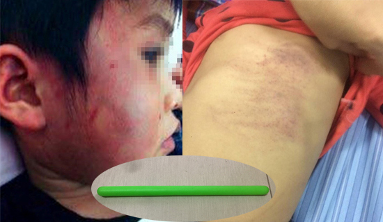 Kỷ luật giáo viên vụ bé gái bị đánh bầm tím khắp người ở Bắc Giang - Ảnh 1
