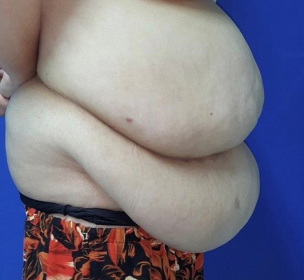 Thu nhỏ bụng “siêu khủng” cho bệnh nhân béo phì - Ảnh 1
