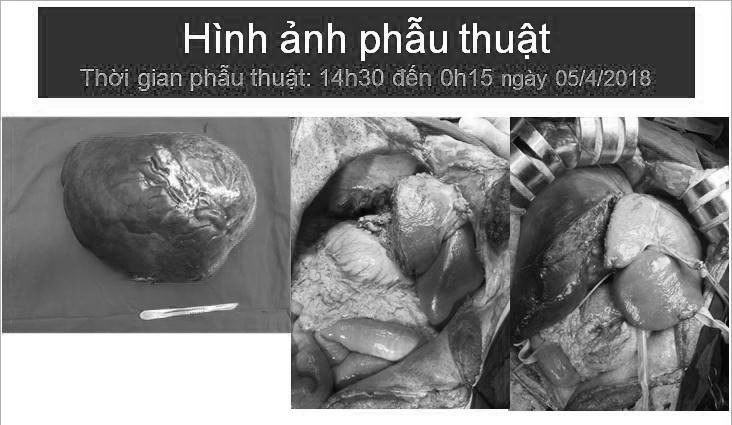 Cắt khối u gan khổng lồ thành công - Ảnh 1