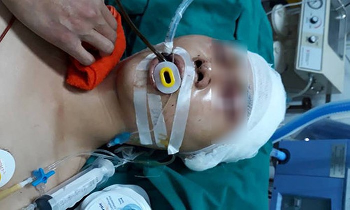 Hà Nội: Nam sinh cấp ba bị đánh chấn thương sọ não ở Long Biên - Ảnh 1