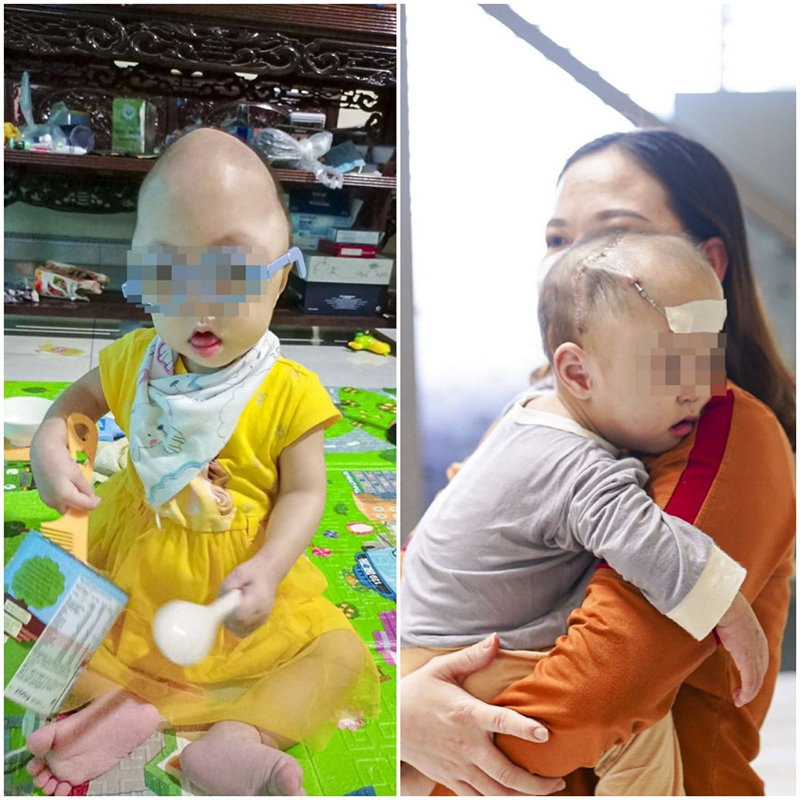 Phẫu thuật tạo hình thành công cho bé 16 tháng tuổi mắc dị tật sọ mặt hiếm gặp - Ảnh 3
